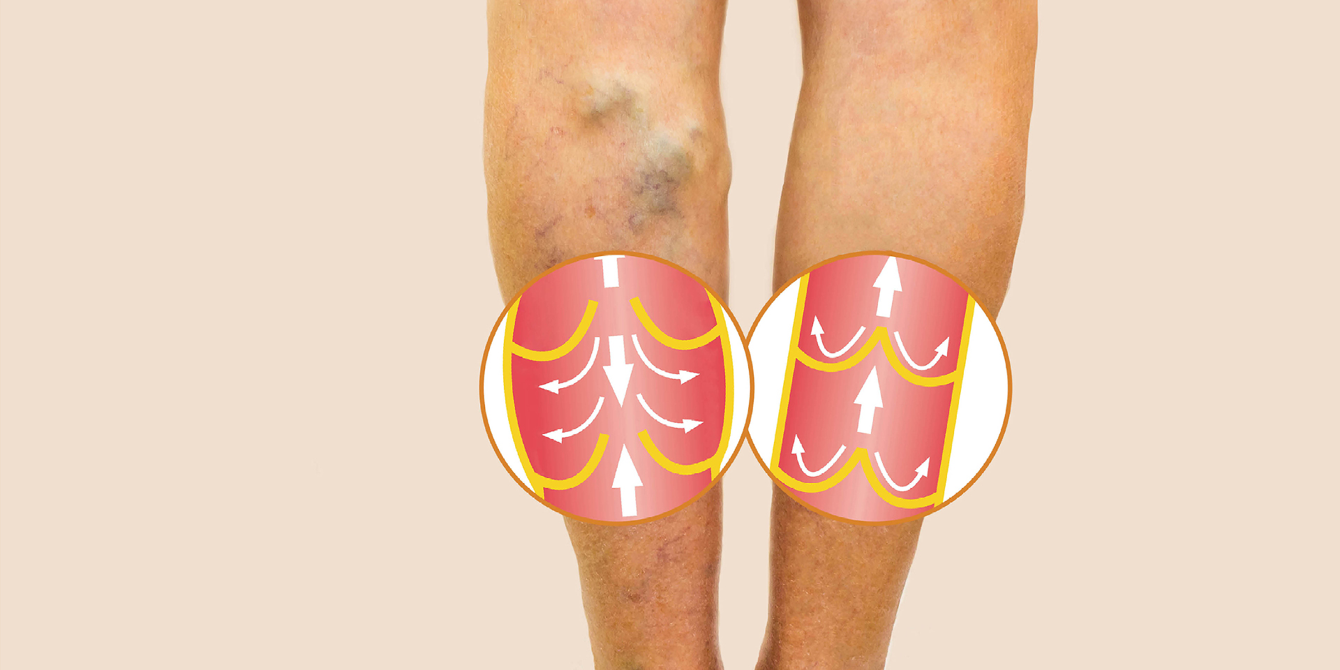 back of legs with varicose veins